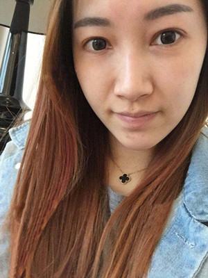 重慶五洲女子醫(yī)院整形美容中心做光子嫩膚怎么樣？淡明斌醫(yī)生光子嫩膚案例