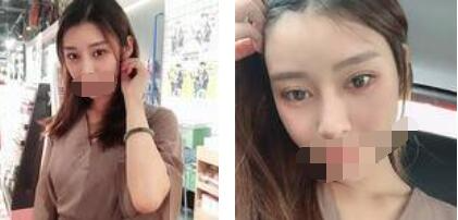 太原歐美蓮整形醫(yī)院丁曉峰醫(yī)生做雙眼皮怎么樣？丁曉峰雙眼皮手術(shù)案例分享