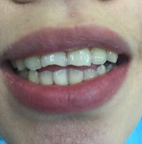 武漢康承貝健口腔醫(yī)院宋磊醫(yī)生做二氧化鋯全瓷牙效果怎么樣？附案例