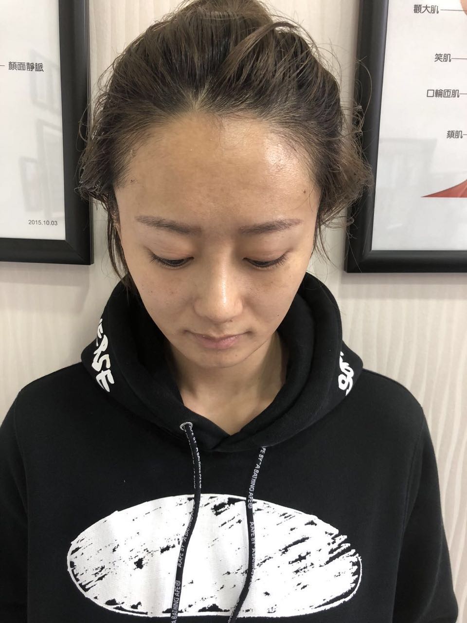 杭州迪美整形常德成醫(yī)生做鼻綜合整形技術(shù)怎么樣？附鼻綜合整形案例