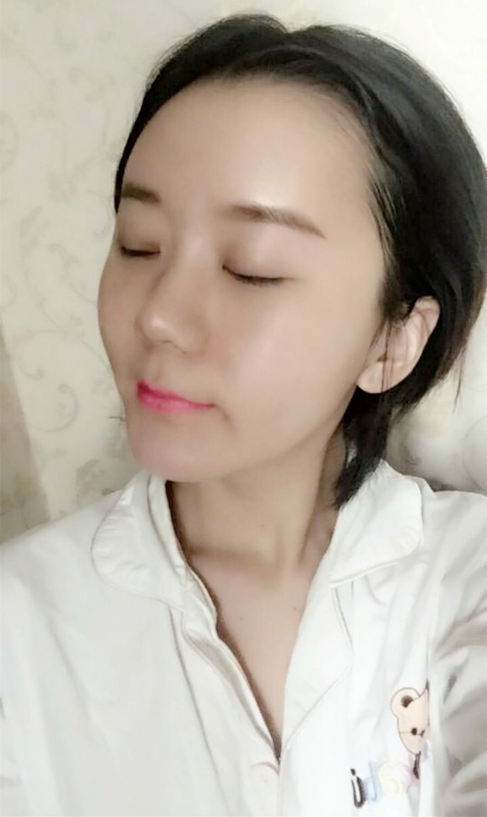 沈陽友誼整形美容醫(yī)院金顕哲醫(yī)生做自體脂肪填充臉部+V-LINE瓜子臉手術(shù)案例效果圖