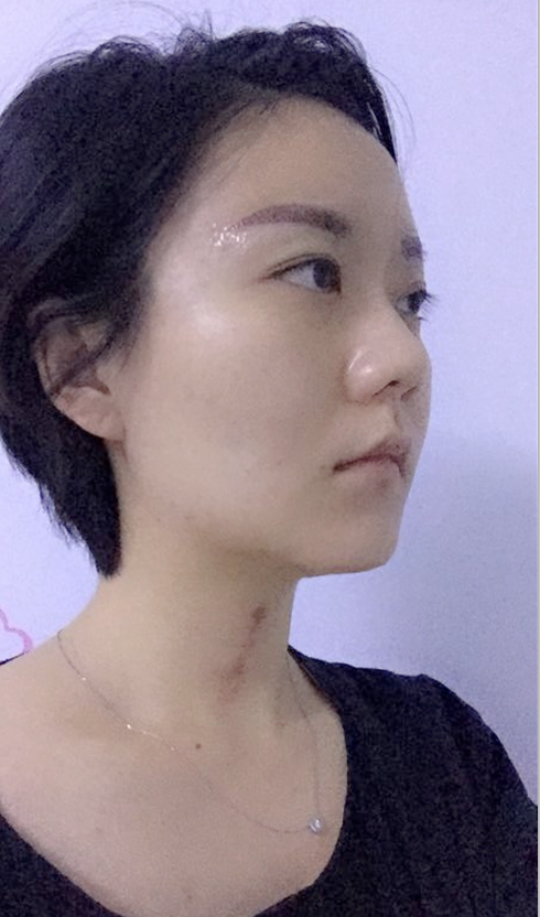 沈陽友誼整形美容醫(yī)院金顕哲醫(yī)生做自體脂肪填充臉部+V-LINE瓜子臉手術(shù)案例效果圖