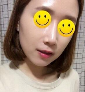 信陽東方藝美容醫(yī)院劉力萌做玻尿酸去法令紋效果怎么樣？附案例效果對比圖