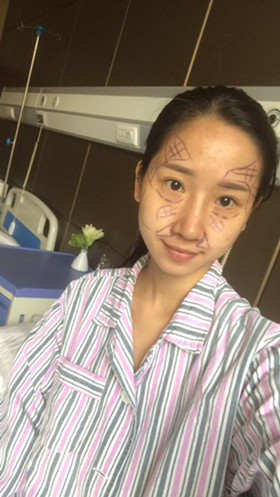 湛江澳泰整形醫(yī)院彭鑫醫(yī)生做自體脂肪豐蘋果肌+太陽穴案例效果對比圖