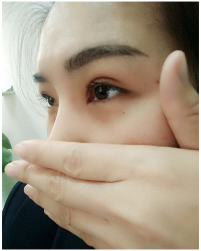 營口臻美醫(yī)療整形醫(yī)生閆迎軍做雙眼皮效果怎么樣？附雙眼皮案例對比圖