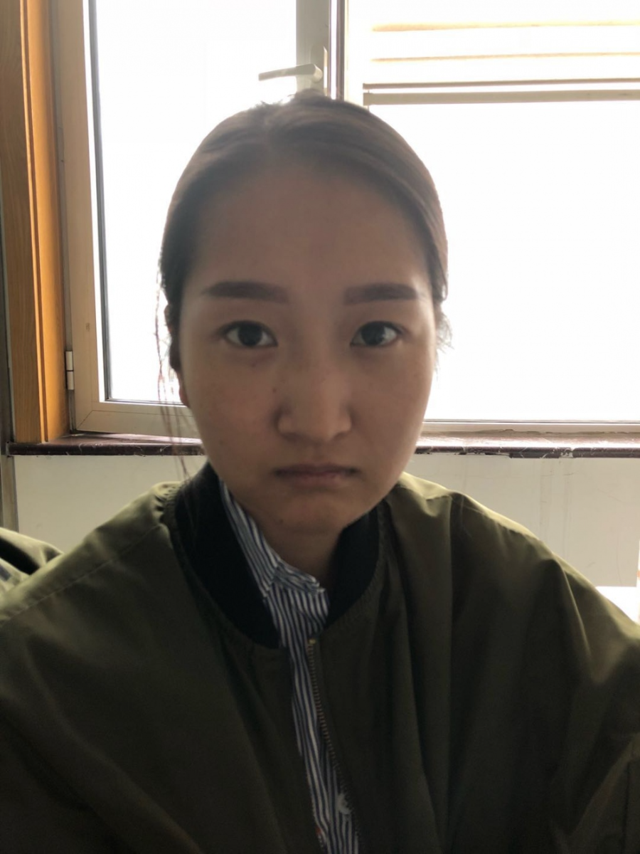 廣州廣大整形美容醫(yī)院任生醫(yī)生做玻尿酸豐面頰+注射瘦臉案例效果對比圖