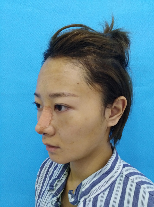 杭州迪美整形常德成醫(yī)生做鼻綜合整形技術(shù)怎么樣？附鼻綜合整形案例