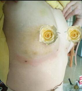 慈溪悅爾整形醫(yī)院趙天宇做自體脂肪隆胸怎么樣？附自體脂肪隆胸案例