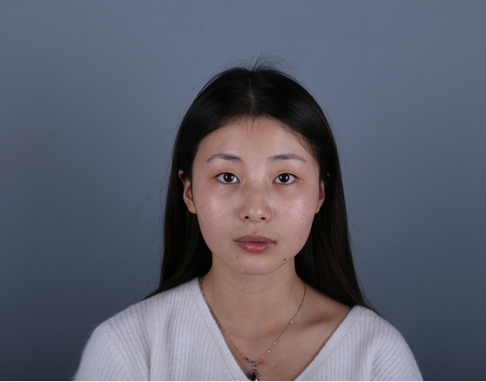桂林新華醫(yī)療美容醫(yī)生李新華做雙眼皮手術(shù)怎么樣？李新華雙眼皮手術(shù)案例