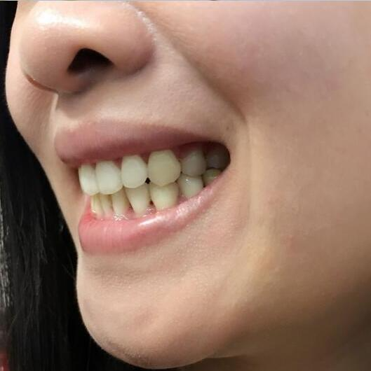重慶嘉悅口腔醫(yī)院周繼祥醫(yī)生做金屬托槽矯正效果怎么樣？附案例效果對比圖