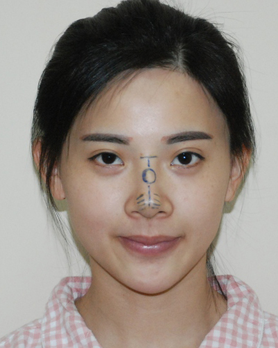 襄陽(yáng)維多利亞整形醫(yī)院安邰晥醫(yī)生做鼻綜合整形怎么樣？附鼻綜合整形案例