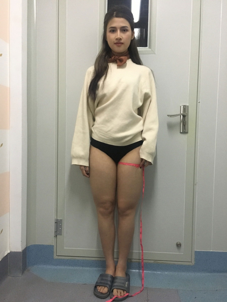 晉城鳳凰整形美容醫(yī)院宋發(fā)興醫(yī)生做大腿吸脂怎么樣？附大腿吸脂案例