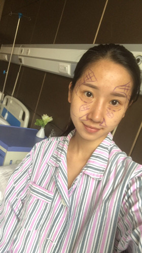 湛江澳泰整形醫(yī)院彭鑫醫(yī)生做自體脂肪豐蘋(píng)果肌+太陽(yáng)穴案例效果對(duì)比圖