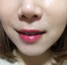 信陽東方藝美容醫(yī)院劉力萌做玻尿酸去法令紋效果怎么樣？附案例效果對比圖