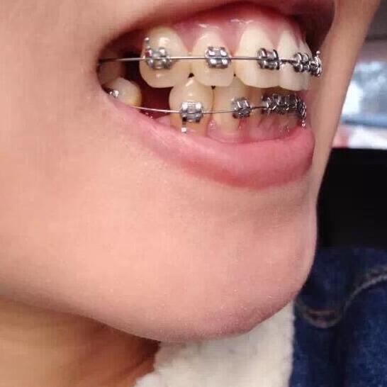 重慶嘉悅口腔醫(yī)院周繼祥醫(yī)生做金屬托槽矯正效果怎么樣？附案例效果對(duì)比圖