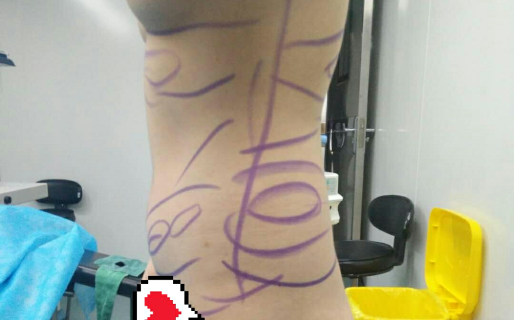 沈陽天使醫(yī)療整形醫(yī)生黃展翼做水動力腰腹吸脂技術(shù)怎么樣？附水動力腰腹吸脂案例