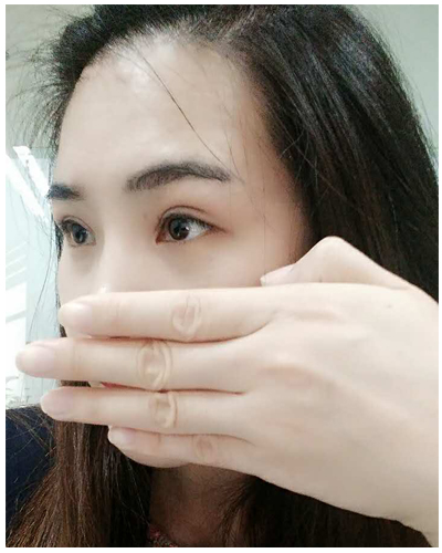 營口臻美醫(yī)療整形醫(yī)生閆迎軍做雙眼皮效果怎么樣？附雙眼皮案例對比圖