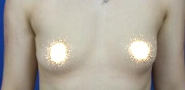 慈溪悅爾整形醫(yī)院趙天宇做自體脂肪隆胸怎么樣？附自體脂肪隆胸案例