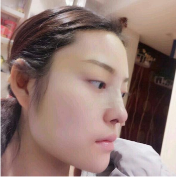 武漢維納斯整形醫(yī)院韓國濤醫(yī)生做鼻綜合整形怎么樣？附鼻綜合整形案例