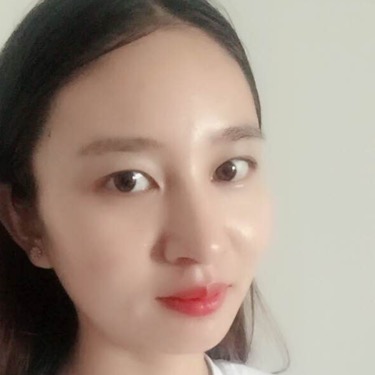 武漢維納斯整形醫(yī)院趙瑾醫(yī)生做玻尿酸墊下巴怎么樣？附玻尿酸墊下巴案例