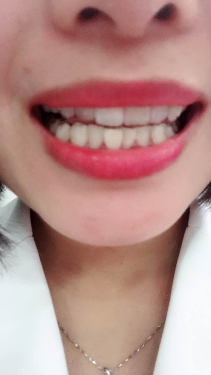 鄭州壹加壹整形醫(yī)院楊永利醫(yī)生做牙齒隱形矯正怎么樣？附牙齒隱形矯正案例