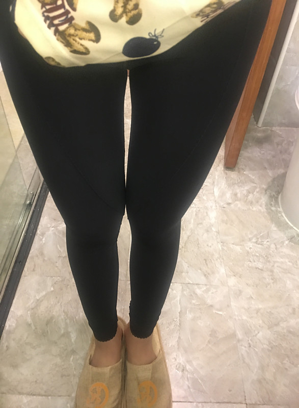 晉城鳳凰整形美容醫(yī)院宋發(fā)興醫(yī)生做大腿吸脂怎么樣？附大腿吸脂案例