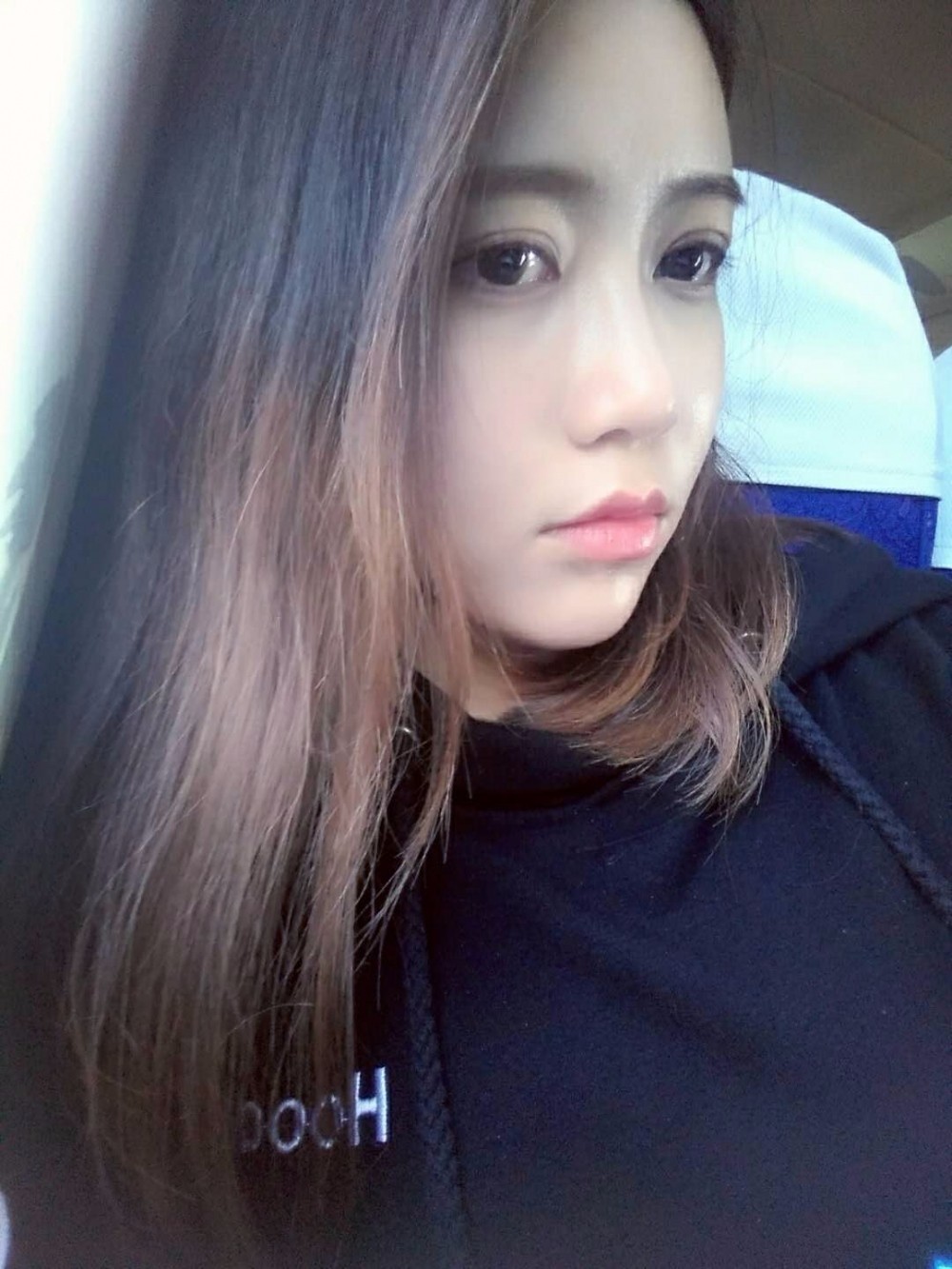 重慶美圣美邦整形醫(yī)院劉力維醫(yī)生做自體脂肪全臉填充案例效果對(duì)比圖