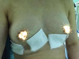 慈溪悅爾整形醫(yī)院趙天宇做自體脂肪隆胸怎么樣？附自體脂肪隆胸案例