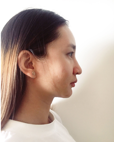 武漢維納斯整形醫(yī)院趙瑾醫(yī)生做玻尿酸墊下巴怎么樣？附玻尿酸墊下巴案例