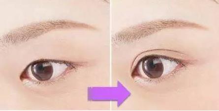 哈爾濱禾力康整形雙眼皮