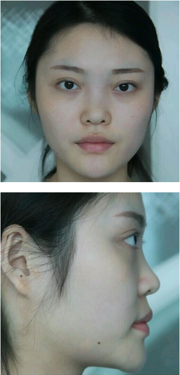 武漢維納斯整形醫(yī)院韓國濤醫(yī)生做鼻綜合整形怎么樣？附鼻綜合整形案例