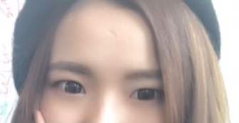 長春麥西美嘉整形醫(yī)生王圣博做雙眼皮手術效果怎么樣？附雙眼皮案例