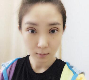 武漢中翰整形外科醫(yī)院陳志鵬醫(yī)生做雙眼皮修復(fù)效果怎么樣？附雙眼皮修復(fù)案例