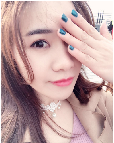 營口臻美醫(yī)療整形醫(yī)生閆迎軍做雙眼皮效果怎么樣？附雙眼皮案例對比圖