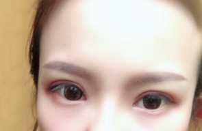 長春麥西美嘉整形醫(yī)生王圣博做雙眼皮手術效果怎么樣？附雙眼皮案例