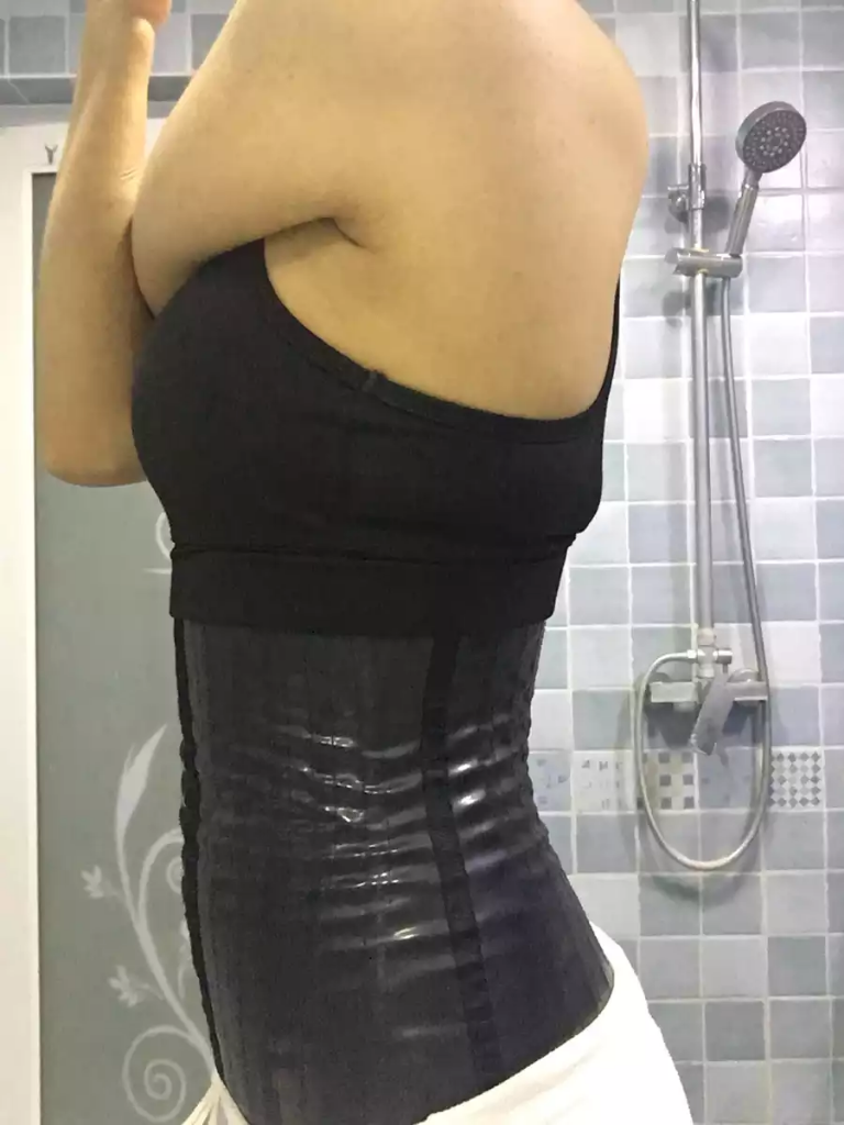 沈陽(yáng)天使醫(yī)療整形醫(yī)生黃展翼做水動(dòng)力腰腹吸脂技術(shù)怎么樣？附水動(dòng)力腰腹吸脂案例