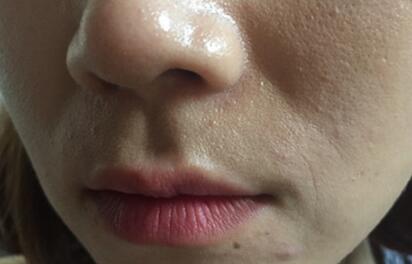 信陽東方藝美容醫(yī)院劉力萌做玻尿酸去法令紋效果怎么樣？附案例效果對比圖