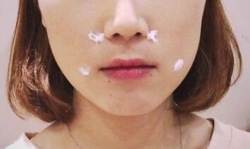 信陽東方藝美容醫(yī)院劉力萌做玻尿酸去法令紋效果怎么樣？附案例效果對比圖