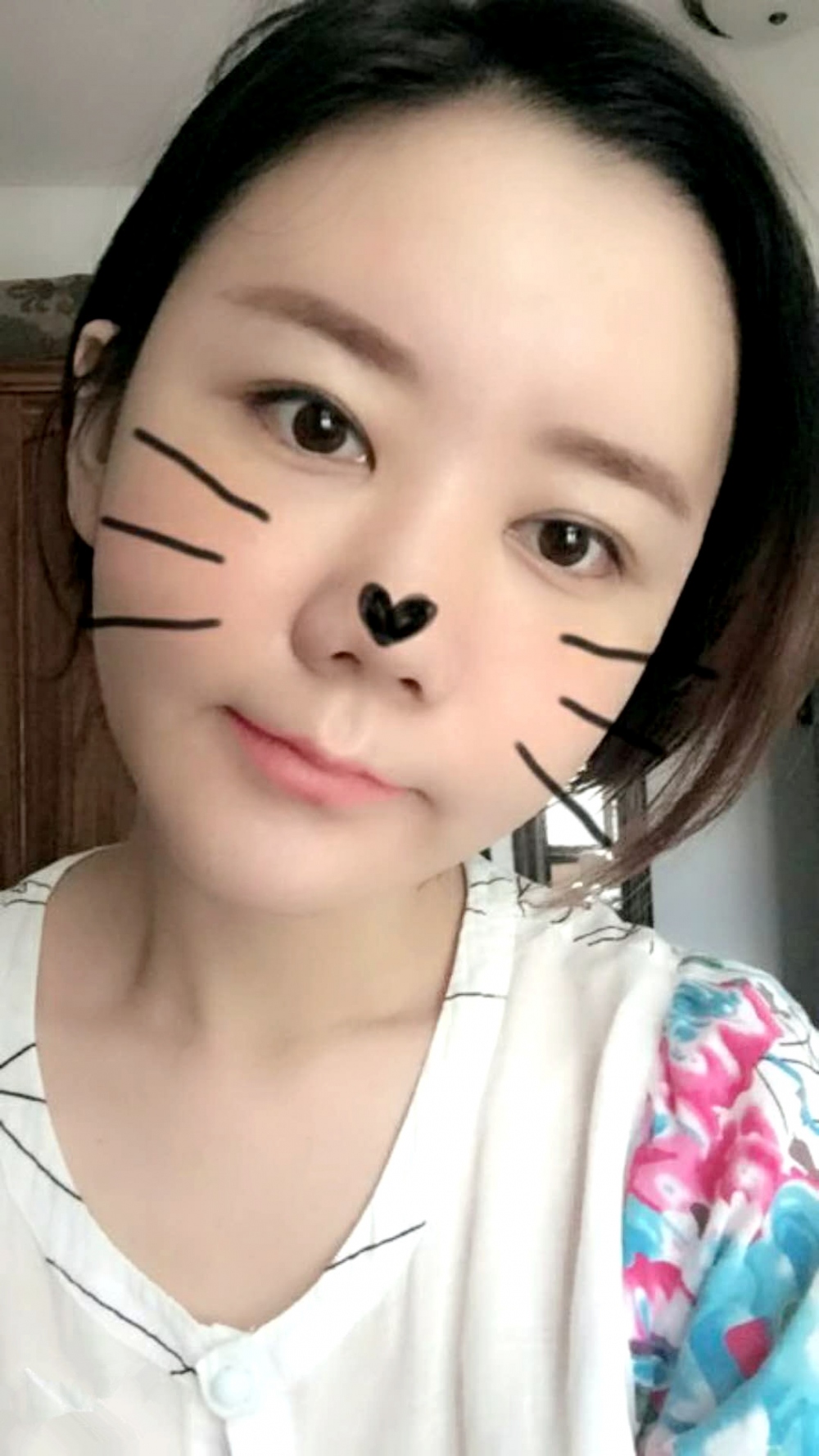 沈陽友誼整形美容醫(yī)院金顕哲醫(yī)生做自體脂肪填充臉部+V-LINE瓜子臉手術(shù)案例效果圖