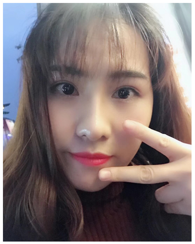 營口臻美醫(yī)療整形醫(yī)生閆迎軍做雙眼皮效果怎么樣？附雙眼皮案例對比圖