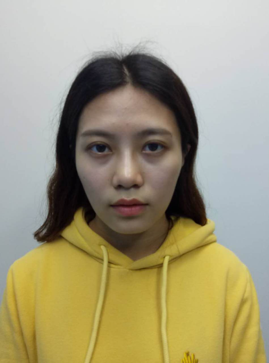 重慶美圣美邦整形醫(yī)院劉力維醫(yī)生做自體脂肪全臉填充案例效果對(duì)比圖