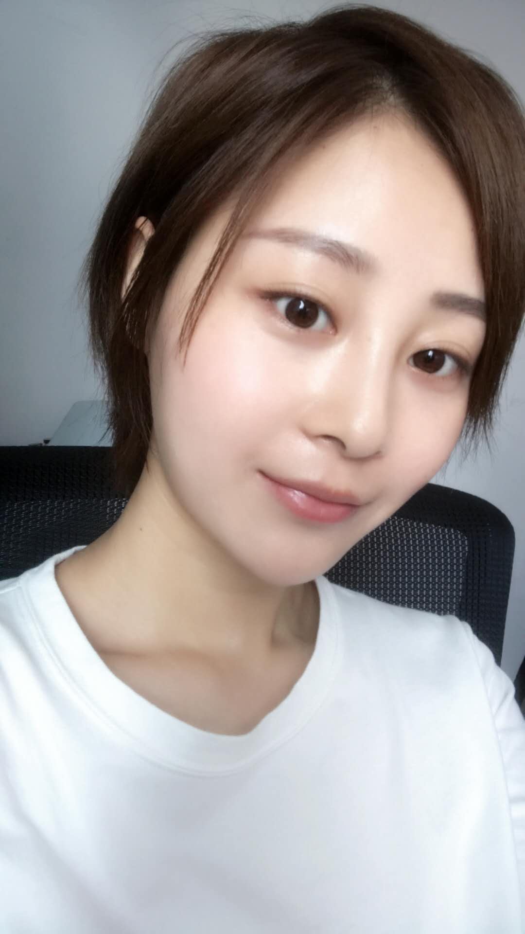 天津歐華威莎整形醫(yī)生姚玲做面部埋線提升效果怎么樣？附埋線提升案例