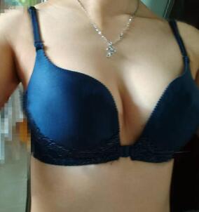 慈溪悅爾整形醫(yī)院趙天宇做自體脂肪隆胸怎么樣？附自體脂肪隆胸案例