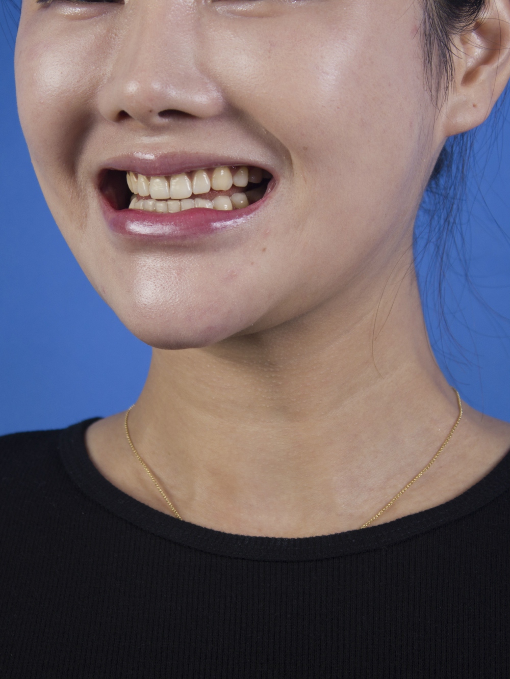 廣州柏德口腔蘭海龍醫(yī)生做瓷貼面效果怎么樣？廣州柏德口腔瓷貼面案例分享