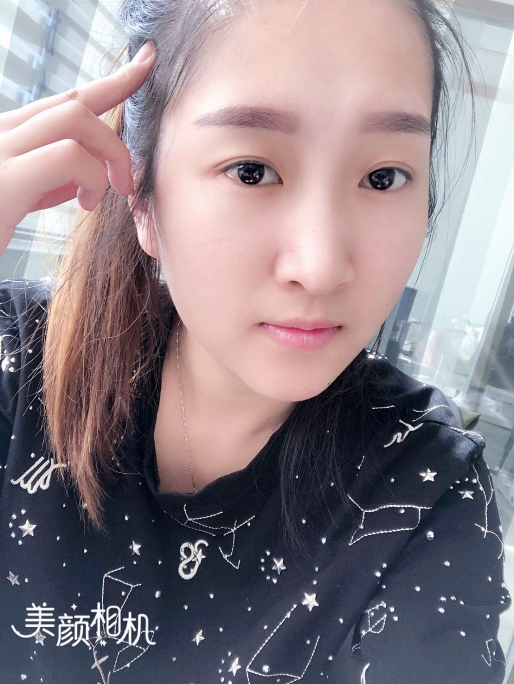 廣州廣大整形美容醫(yī)院任生醫(yī)生做玻尿酸豐面頰+注射瘦臉案例效果對比圖