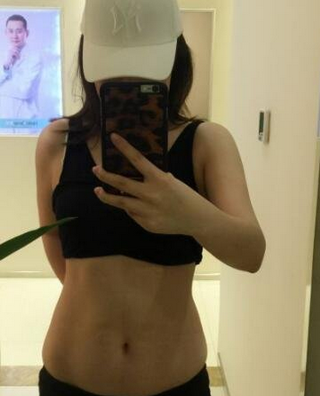 成都蜀尚蓉雅整形醫(yī)生張知華做腰腹吸脂效果怎么樣？附腰腹吸脂案例