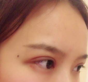 長春麥西美嘉整形醫(yī)生王圣博做雙眼皮手術效果怎么樣？附雙眼皮案例