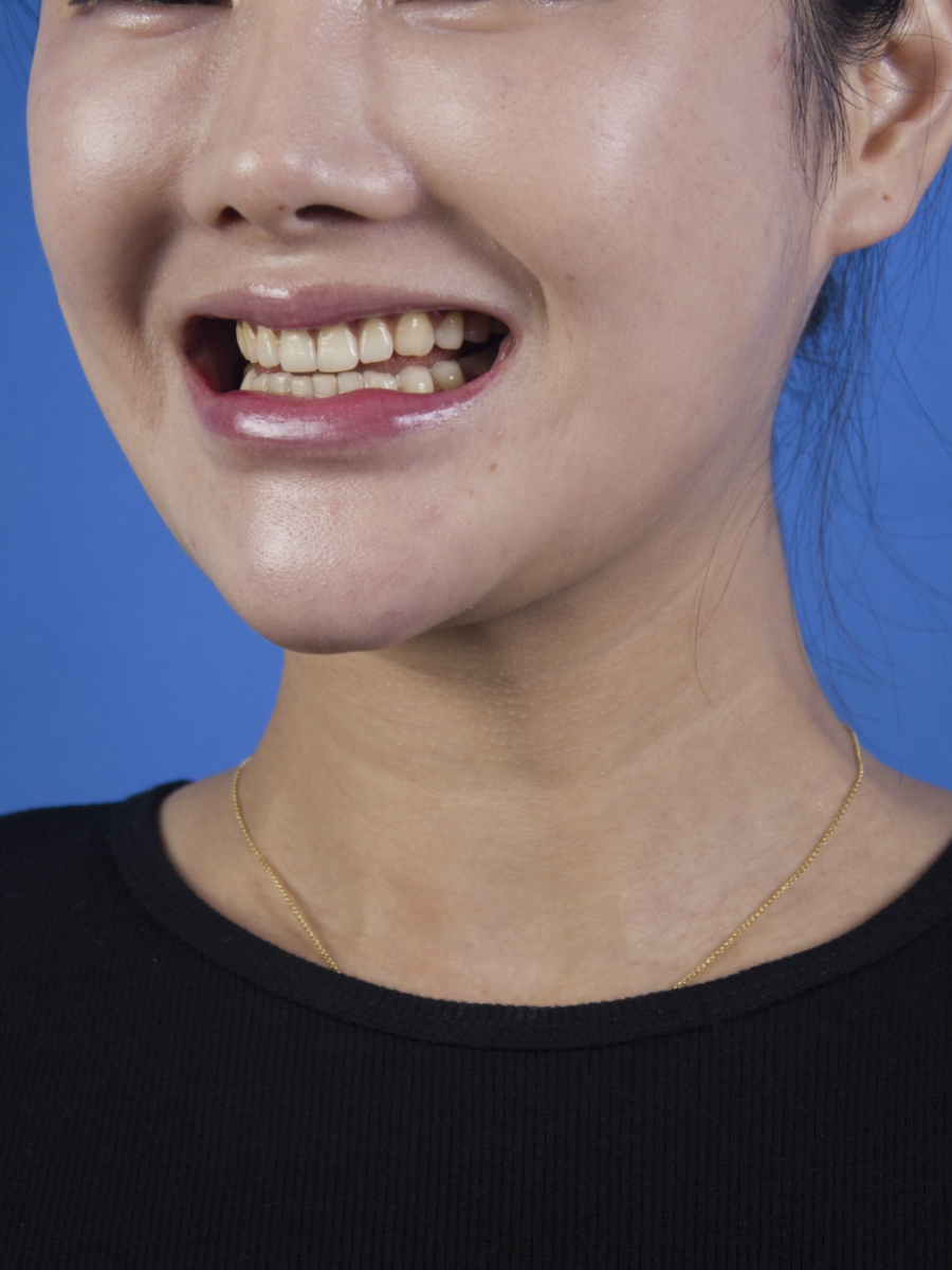 廣州柏德口腔蘭海龍醫(yī)生做瓷貼面效果怎么樣？廣州柏德口腔瓷貼面案例分享