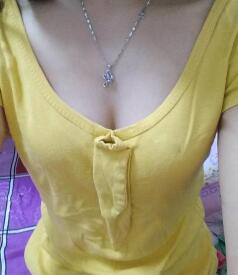 慈溪悅爾整形醫(yī)院趙天宇做自體脂肪隆胸怎么樣？附自體脂肪隆胸案例