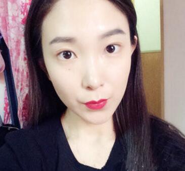 武漢中翰整形外科醫(yī)院陳志鵬醫(yī)生做雙眼皮修復(fù)效果怎么樣？附雙眼皮修復(fù)案例